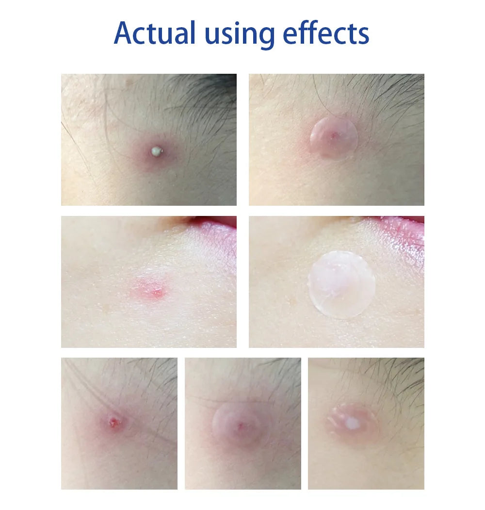 LANBENA Acne Pimple Patch – Day Use